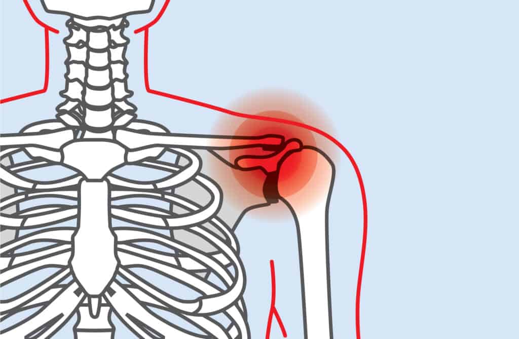 x ray showing shoulder pain 