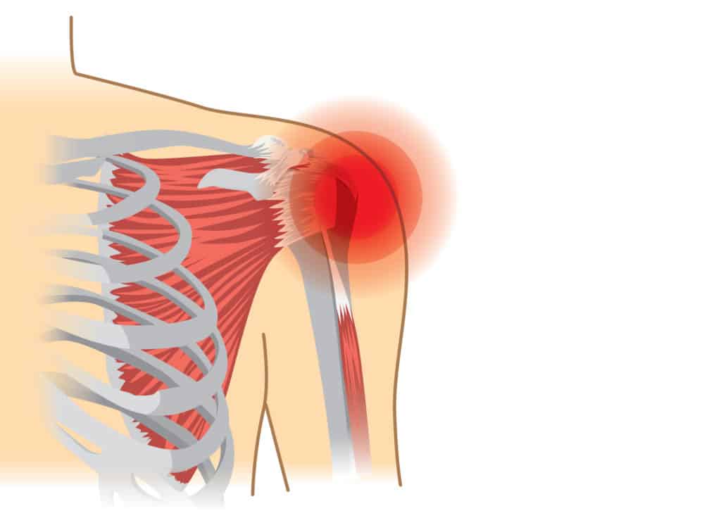 What Are The Symptoms Of Frozen Shoulder? 