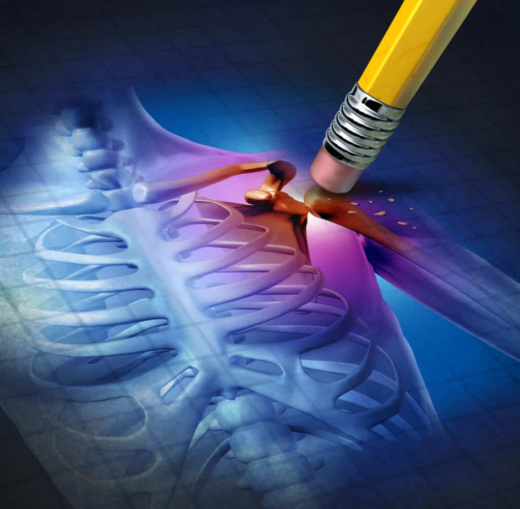 Myofascial Pain Syndrome 