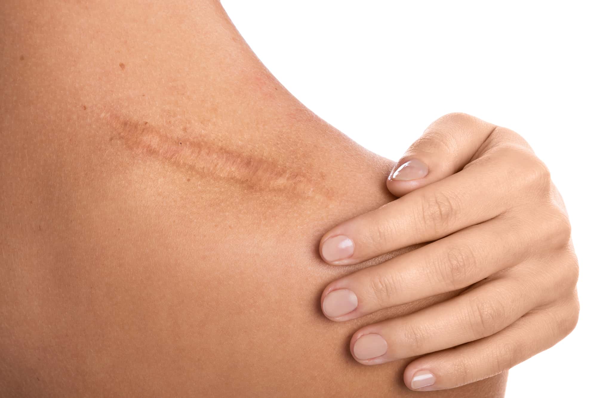 Can I Avoid Getting Scar Tissue After Surgery?