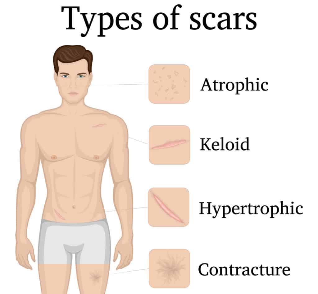 Scar Tissue After Surgery 