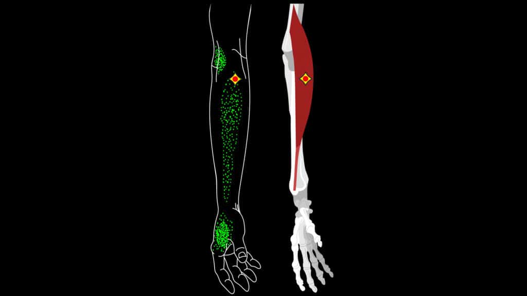 Brachioradialis muscle. Pain and trigger points in the hand. Muscles of the arm. Reflected pain in the arm