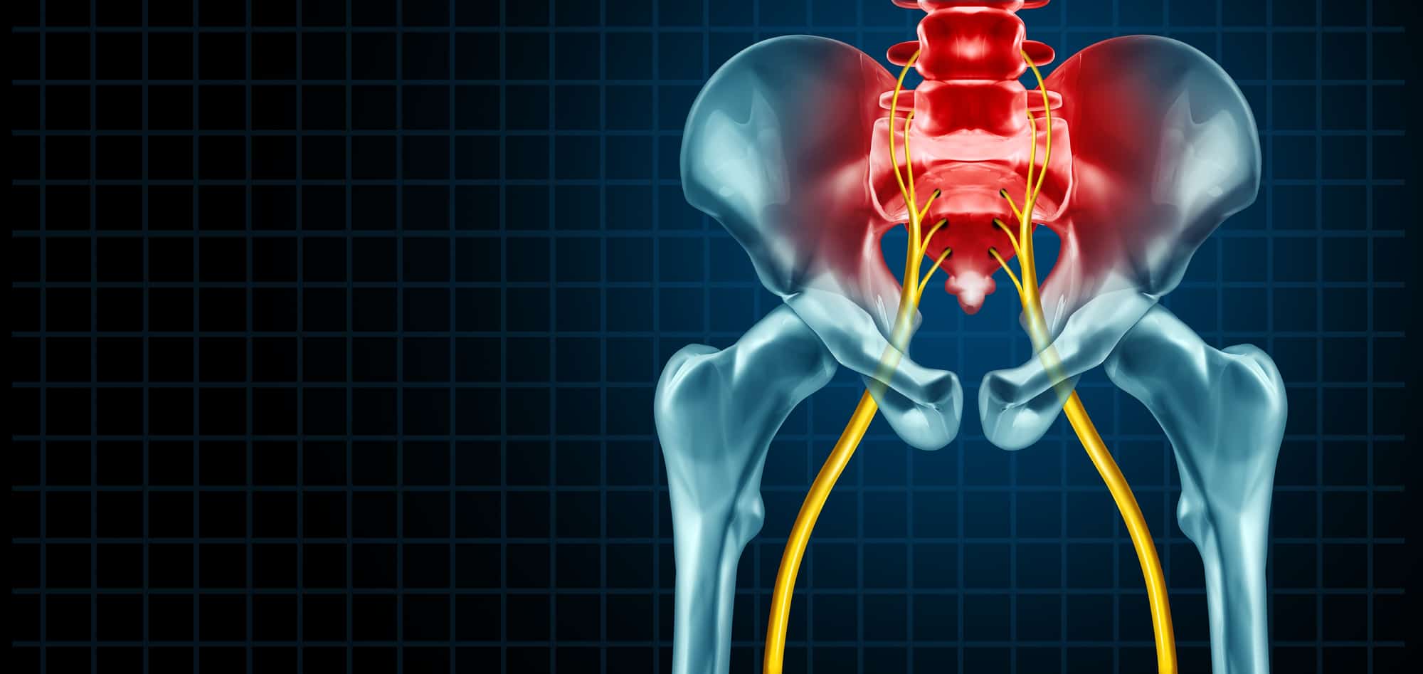 Can I Relieve Pain Caused by Sciatica With Myofascial Release?