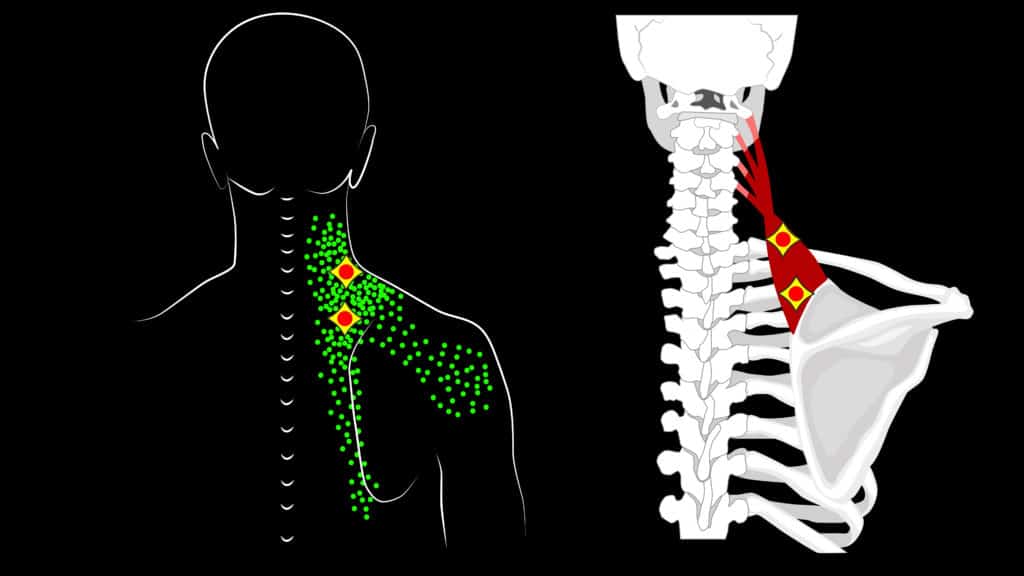 Trigger Points In The Human Body 