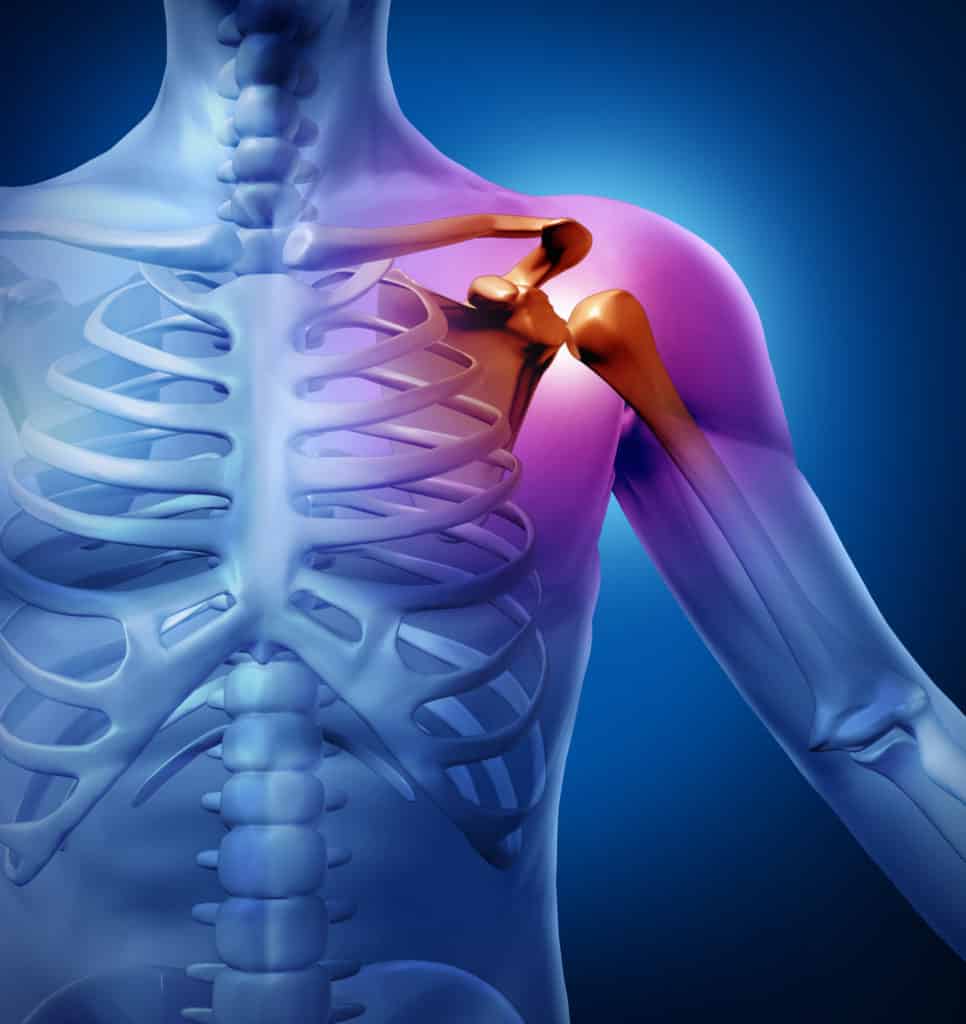 What Is Frozen Shoulder?