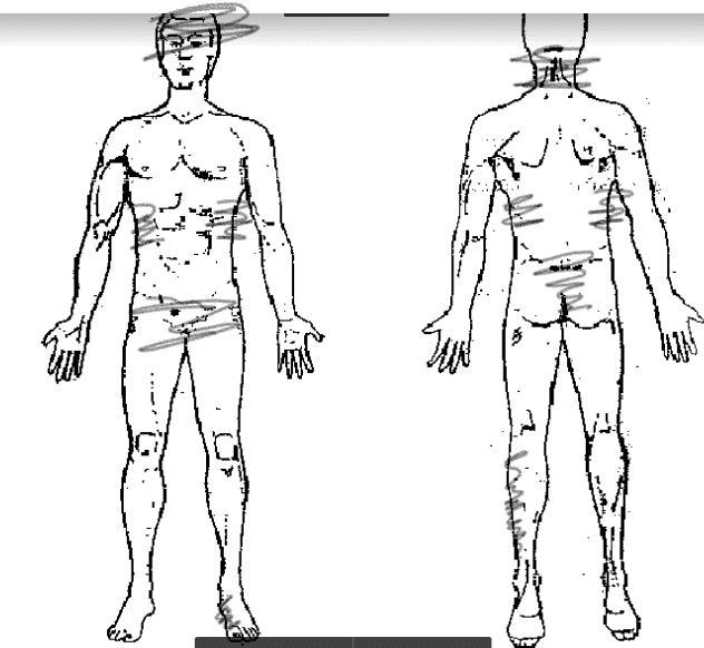 What does it mean when “things hurt more” after your myofascial release sessions?